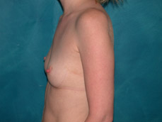 Breast Augmentation