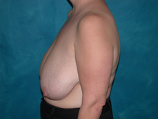 Breast Reduction